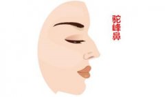 驼峰鼻矫正果自然嘛