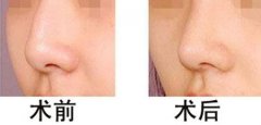 驼峰鼻矫正有没有副作用