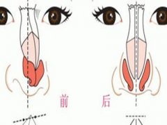 驼峰鼻矫正价钱是多少