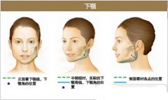 下颌角肥大矫正术怎么样 下颌角肥大矫正术怎么样