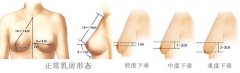 乳房下垂矫正的方法 乳房下垂矫正的方法
