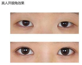 眼角开大了,可以缩小吗