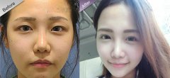 割双眼皮后一高一低怎么办 割双眼皮后一高一低怎么办
