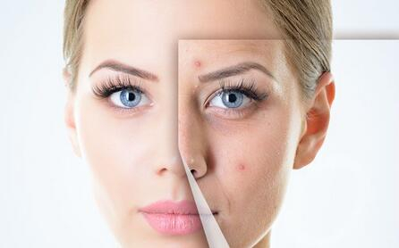 痘痘粉刺,红光,多久有果