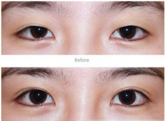 双眼皮整形失败修复术注意事项