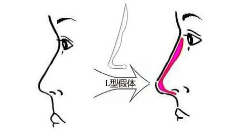 假体隆鼻示意图