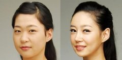 双眼皮手术的**指标是什么 双眼皮手术的**指标是什么