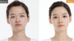 做双眼皮手术的注意事项 做双眼皮手术的注意事项