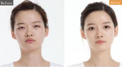 做双眼皮手术的注意事项