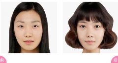 双眼皮手术后该如何护理 双眼皮手术后该如何护理