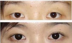 双眼皮手术为何现在越来越多要选择去做 双眼皮手术为何现在越来越多要选择去做