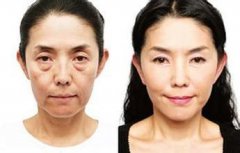 去眼袋手术后遗症有哪些 去眼袋手术后遗症有哪些