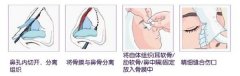 自体软骨隆鼻尖的优点有哪些呢 自体软骨隆鼻尖的优点有哪些呢