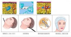 吸脂瘦脸有没有什么副作用