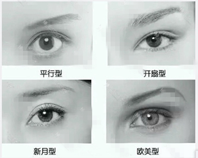 成功的双眼皮,标准是什么
