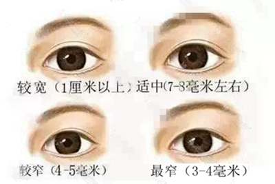 成功的双眼皮,标准是什么
