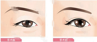 成功的双眼皮,标准是什么