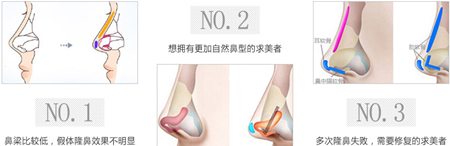 自体软骨,隆鼻,材料,有哪些