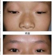 眼睑内翻或外翻如何矫正