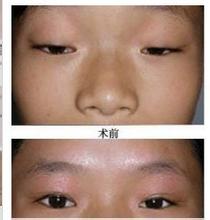 眼睑内翻或外翻如何矫正