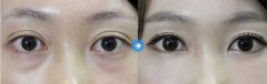 去眼袋术后如何护理 去眼袋术后如何护理