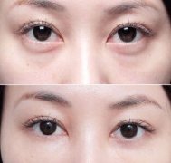吸脂去眼袋会反弹吗 吸脂去眼袋会反弹吗