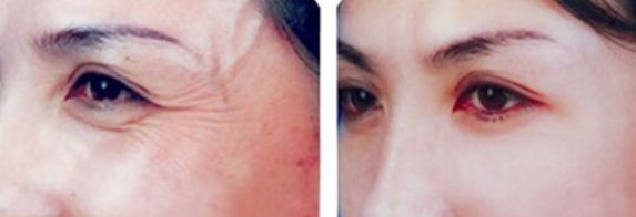 玻尿酸怎么去除鱼尾纹