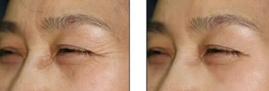 鱼尾纹怎么去除