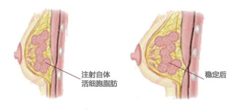 上海抽脂隆胸：价格透明，安全可靠