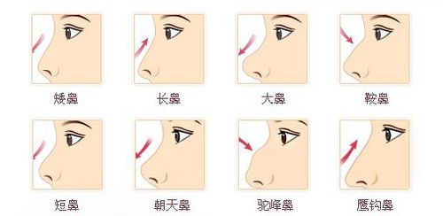 杭州隆鼻手术价格是多少了