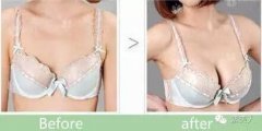 妙桃假体隆胸价格 妙桃假体隆胸多少钱