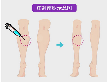 注射瘦脸注射,瘦腿,有什么优势