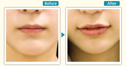 玻尿酸丰唇珠,会痛吗