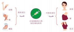 自体脂肪移植多久可以消肿