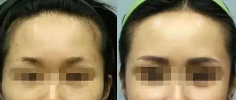 自体脂肪丰太阳穴能维持多久