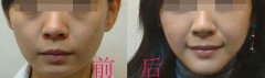 玻尿酸隆下巴有哪些优势 玻尿酸隆下巴有哪些优势