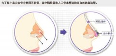 隆鼻术后多久消肿