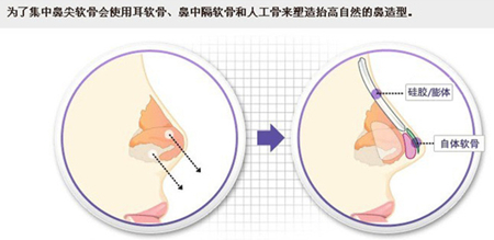 隆鼻,术后,多久消肿