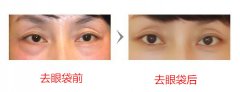 有的去眼袋手术方法 有的去眼袋手术方法