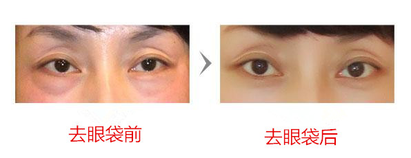 有的去眼袋手术方法