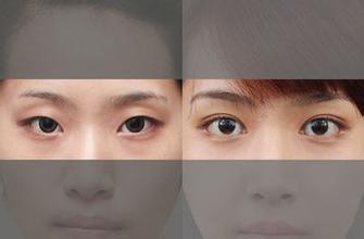 欧式大宽全切双眼皮前后对比