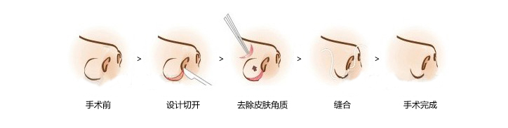 鼻头缩小,术后,多久,消肿