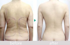 北京东方和谐张准吸脂怎么样