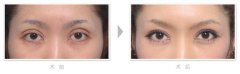 眼部整形美容手术失败修复对比图