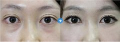 缓解眼袋的喜欢方法 缓解眼袋的喜欢方法