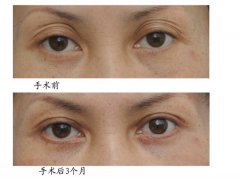 双眼皮手术失败修复对比图