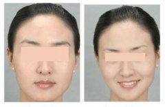 提眉手术前后对比图