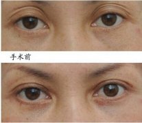 失败双眼皮修复方法