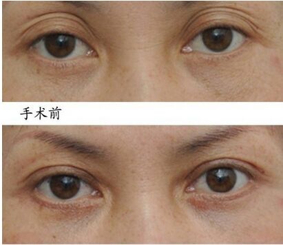 失败双眼皮修复方法