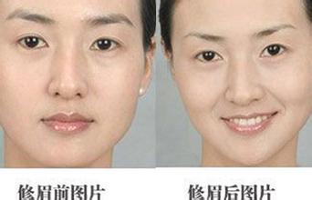 韩国精细提眉术前后对比照片